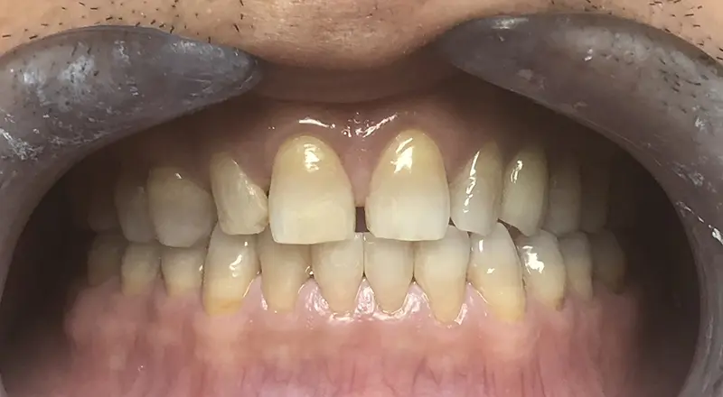 Composite Restorations & Cavity Treatment 4
