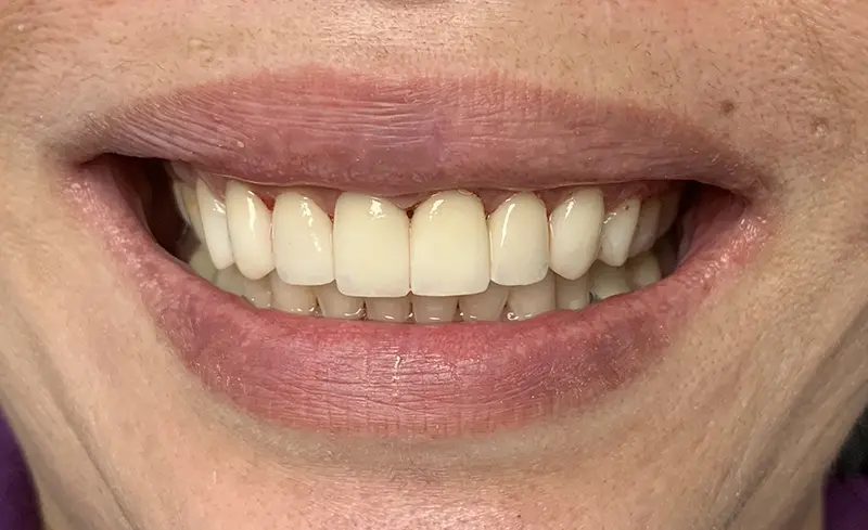 Cosmetic Veneers & Crowns 3