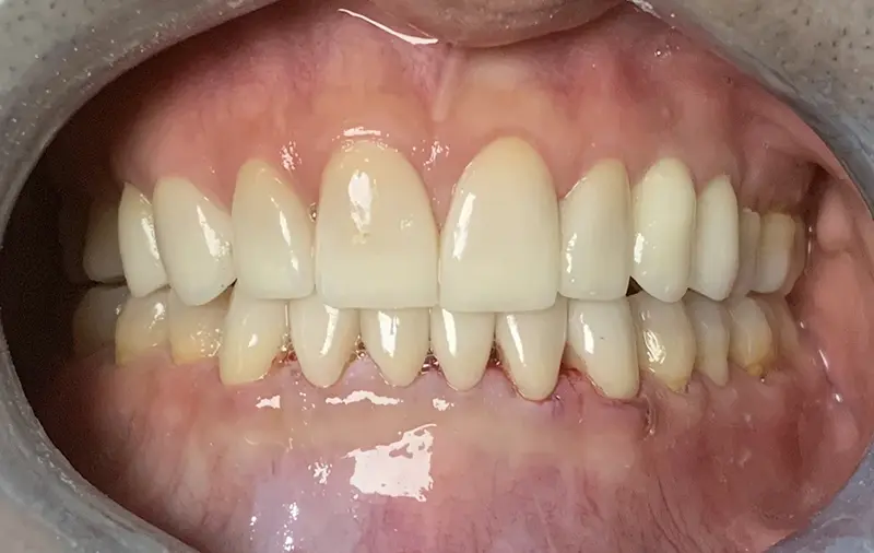 Cosmetic Veneers & Crowns 4