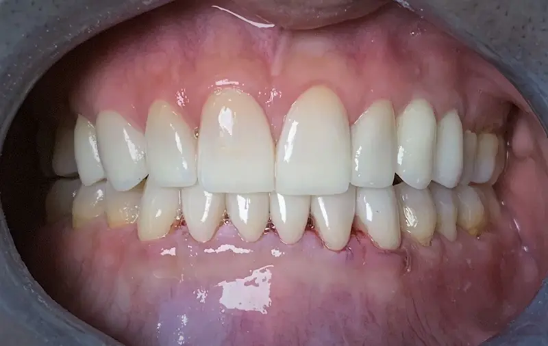 Cosmetic Veneers & Crowns 5