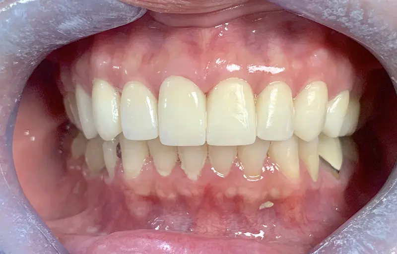 Cosmetic Veneers & Crowns 7