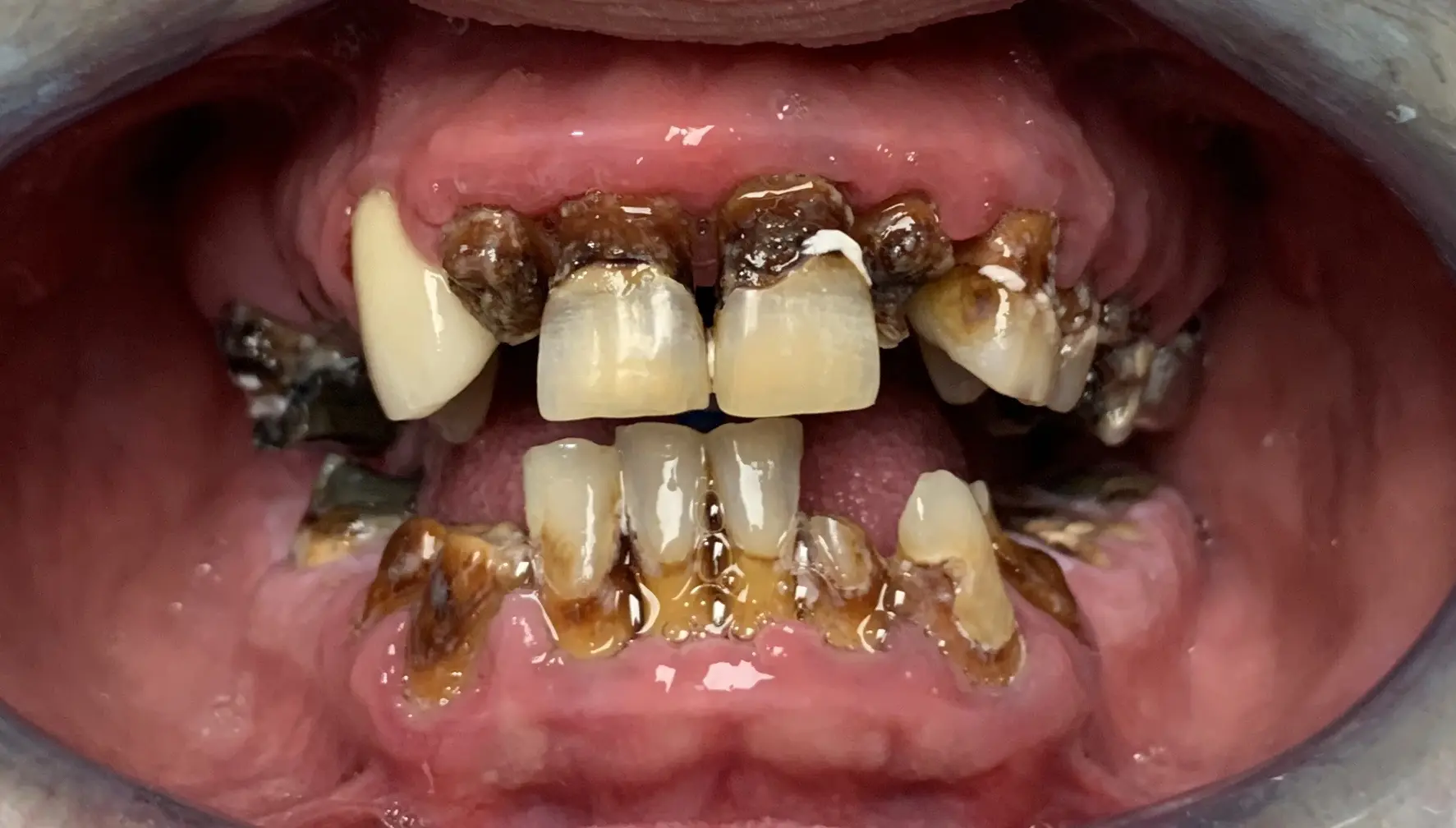 Full Mouth Reconstruction 1