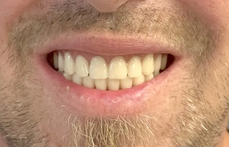 Full Mouth Reconstruction 2