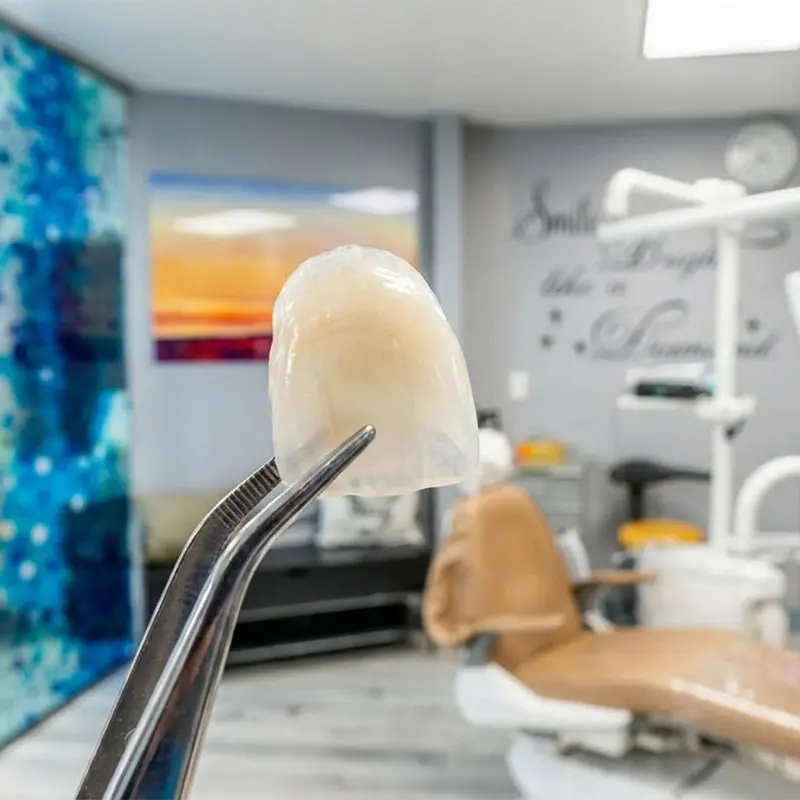 Close-up of Porcelain Veneers