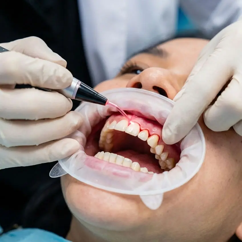 Gum contouring for a balanced smile