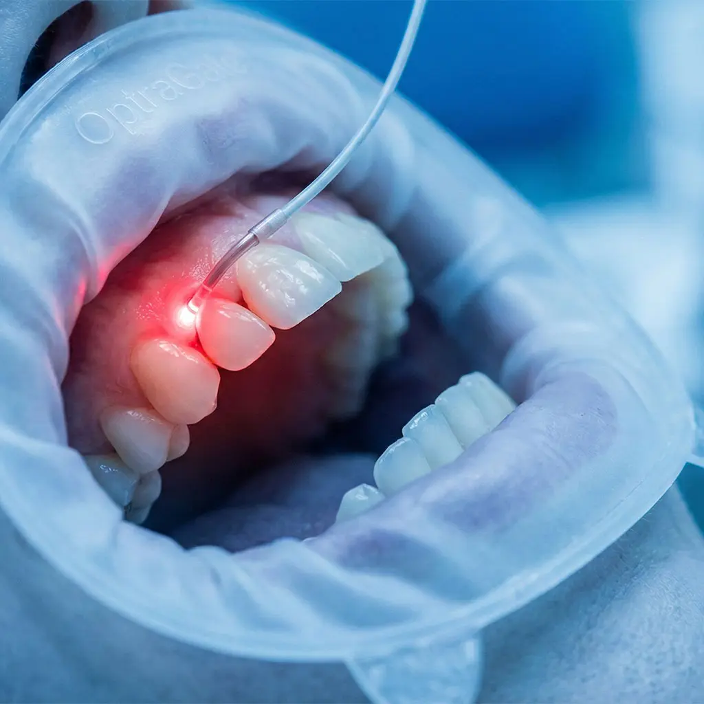 Laser gum therapy treating bacteria