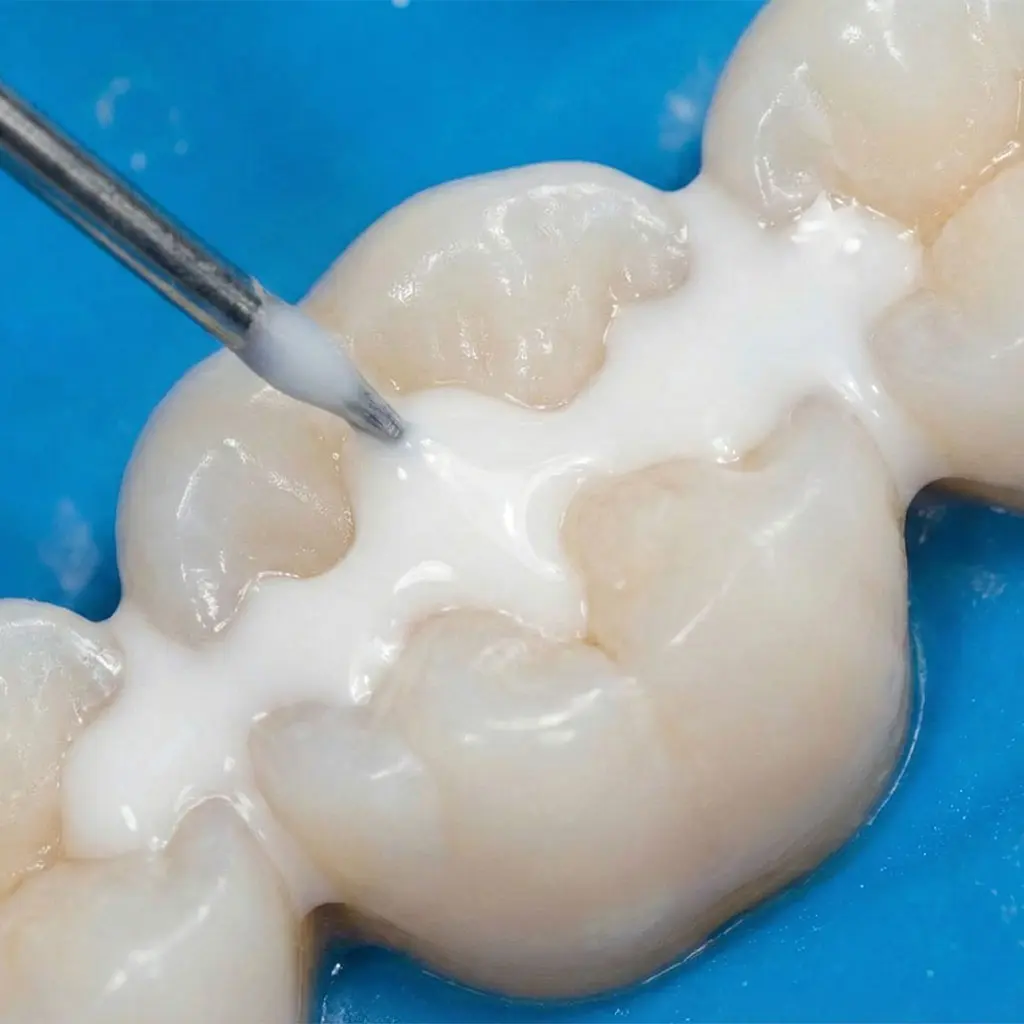 Dentist applying dental sealants to child's teeth